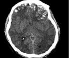 Les traumatismes crâniens augmentent les risques de maladie d'Alzheimer