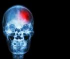 L'inflammation du cerveau augmenterait les risques de suicide