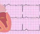 L’Intelligence Artificielle s’impose contre l’arythmie cardiaque…