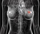 L'obésité augmente d'un tiers le risque de certains cancers du sein avant la ménopause
