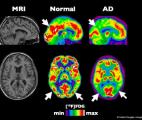 Maladie d'Alzheimer : évaluer par imagerie la perte synaptique chez les malades
