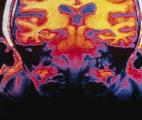 Maladie d'Alzheimer : l'inflammation systémique est liée à un risque accru de démence