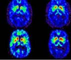 Maladie de Parkinson : NAC, la vitamine qui booste la dopamine