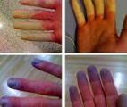 Maladie de Raynaud : découverte de deux gènes impliqués dans cette pathologie douloureuse