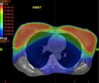 Mastectomie : une radiothérapie accélérée aussi efficace que le traitement standard