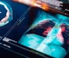 Median Technologies présente une avancée majeure dans le diagnostic du cancer du poumon