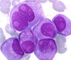 Myélome : l‘interleukine 18 impliquée dans la croissance tumorale