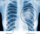 Un nouveau traitement contre le cancer avancé du poumon