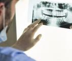 Parodontite et cancer : un lien surprenant