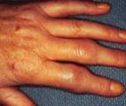Polyarthrite rhumatoïde : une thérapie génique pour apaiser les articulations