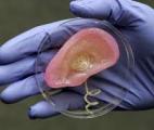Première greffe mondiale réalisée grâce à des os de l’oreille moyenne imprimés en 3D