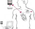 Prévenir l'infarctus grâce à un détecteur électronique  implanté