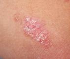 Psoriasis : une nouvelle piste de traitement