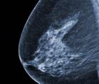 Résultats prometteurs pour un vaccin thérapeutique contre un cancer du sein difficile à traiter