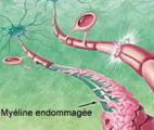 Sclérose en plaque : démarrage d'un essai clinique à l'aide de cellules souches
