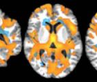 Sclérose en plaques : une accumulation anormale de sodium dans le cerveau mesurée par IRM du sodium témoigne de l'évolution de ...