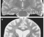 Stimuler le cerveau améliore la mémoire