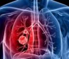 Transgene : 1er patient traité dans l’essai de Phase 2 avec TG4010 dans le cancer du poumon