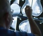 Un essai clinique prometteur pour lutter contre les cancers du sein avancés