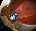 Un implant sous-rétinien restaure partiellement la vision de personnes atteintes de DMLA