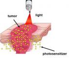 Un laser pour détecter le cancer