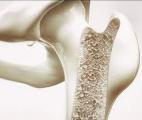 Un nouveau matériau pourrait révolutionner la prise en charge des fractures