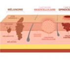Un nouveau traitement plus efficace contre le carcinome épidermoïde
