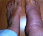 Un nouvel outil pour détecter l'inflammation