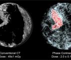 Un scanner à faible rayonnement pour voir le sein en haute définition 