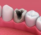 Une bactérie responsable du développement des caries dentaires serait impliquée dans le cancer du côlon