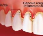 Une maladie des gencives à l’origine de la polyarthrite rhumatoïde ?