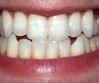 Une mauvaise hygiène dentaire dans l’enfance augmente le risque d’athérosclérose à l’âge adulte