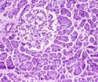Une molécule qui booste la chimiothérapie contre le cancer du pancréas