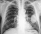 Une nouvelle approche thérapeutique en vue pour le cancer du poumon au stade précoce