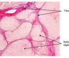 Une nouvelle cible identifiée pour faire régresser la fibrose hépatique