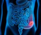 Une nouvelle immunothérapie prometteuse contre le cancer colorectal avancé