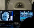 Une nouvelle technique d'IRM pourrait améliorer le diagnostic et le traitement de la sclérose en plaques