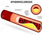 Une nouvelle technique innovante pour vaporiser les plaques d’athérosclérose