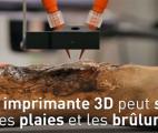 Une nouvelle technique révolutionnaire pour soigner les grands brûlés