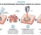 Une thérapie lumineuse contre le cancer de l'ovaire