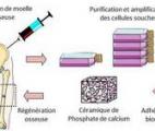 Une thérapie régénérative pour réduire les fractures non consolidées