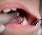 Vers un gel capable de réparer l'émail dentaire