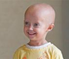 Vers un traitement de la progeria ?