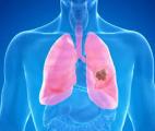Vers un vaccin préventif contre le cancer du poumon